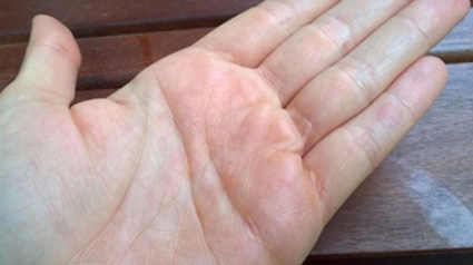 und nach der Pflege mit den Eucerin pH5 Hautschutz Produkten.