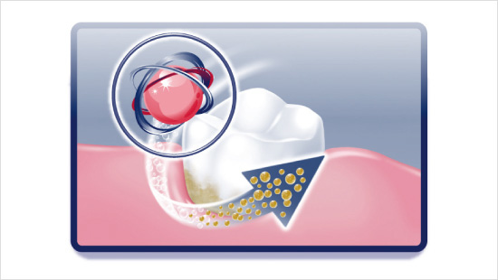 … malkron-Technologie. Sie nutzt eine hohe Konzentration an extra feinem Natriumbicarbonat, um mehr Plaque* zu entfernen und kann so signifikant Zahnfleischbluten reduzieren.