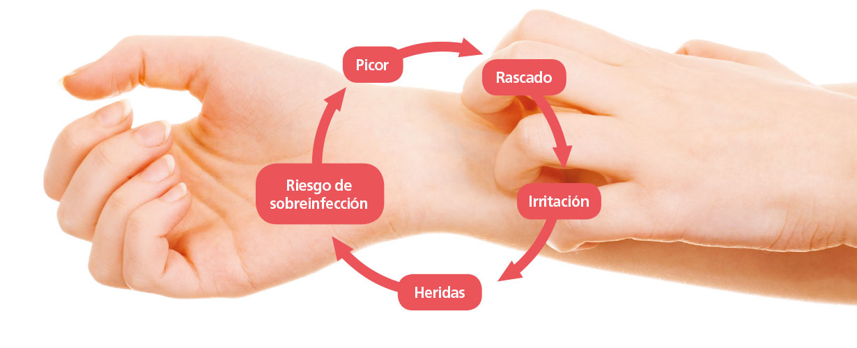 ... y aliviar el picor, la irritación y el malestar causados por esta alteración en nuestra piel.
