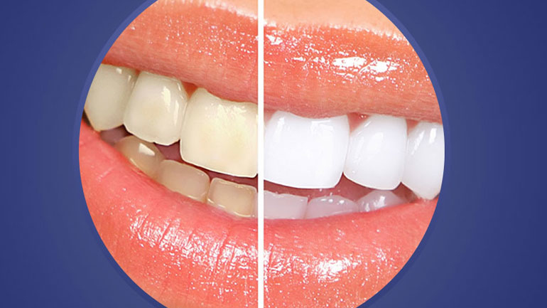 ¿Por qué se oscurecen los dientes?