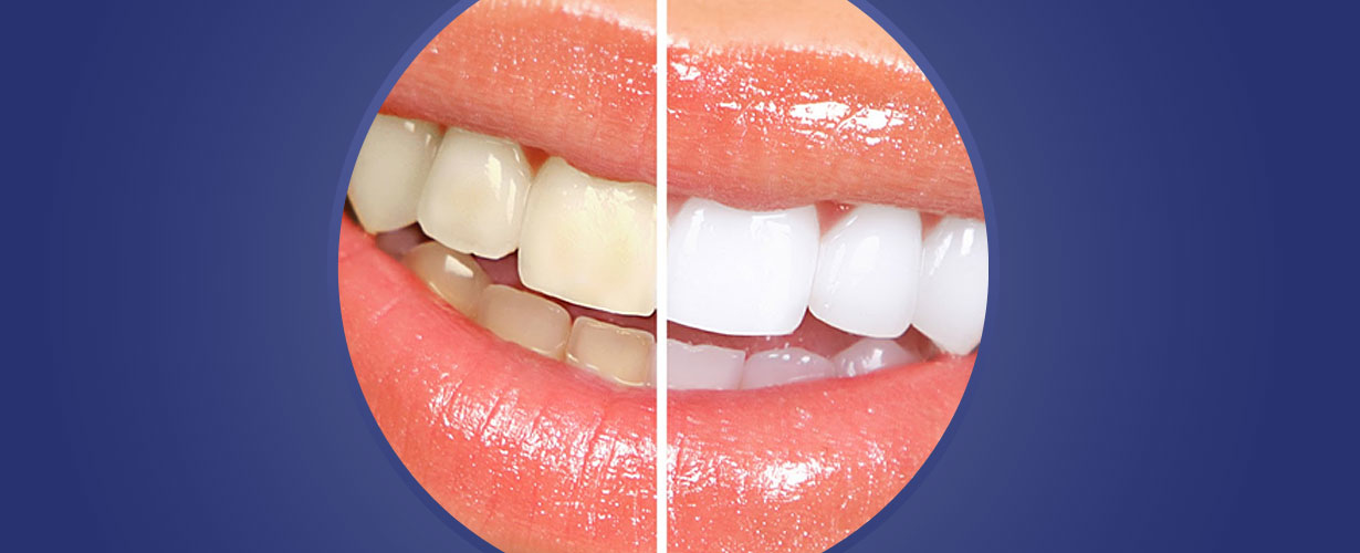 … pero es posible eliminar las manchas protegiendo nuestra dentadura ...