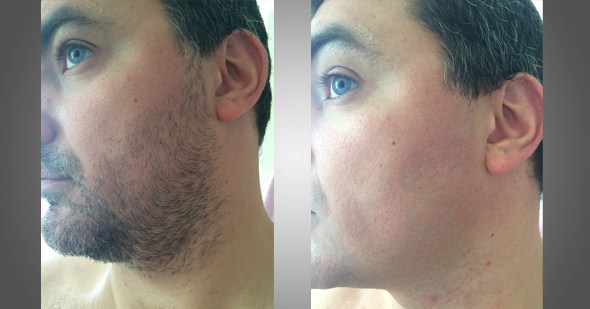 trnder @	Archjulius partage avec nous son : avant / après le rasage électrique Braun !