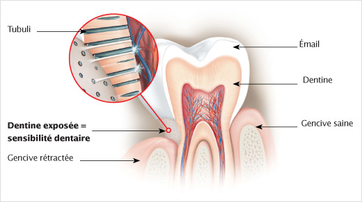 … l’exposition de la dentine qui, lorsqu’elle n’est plus protégée, réagit aux stimuli chauds et froids…