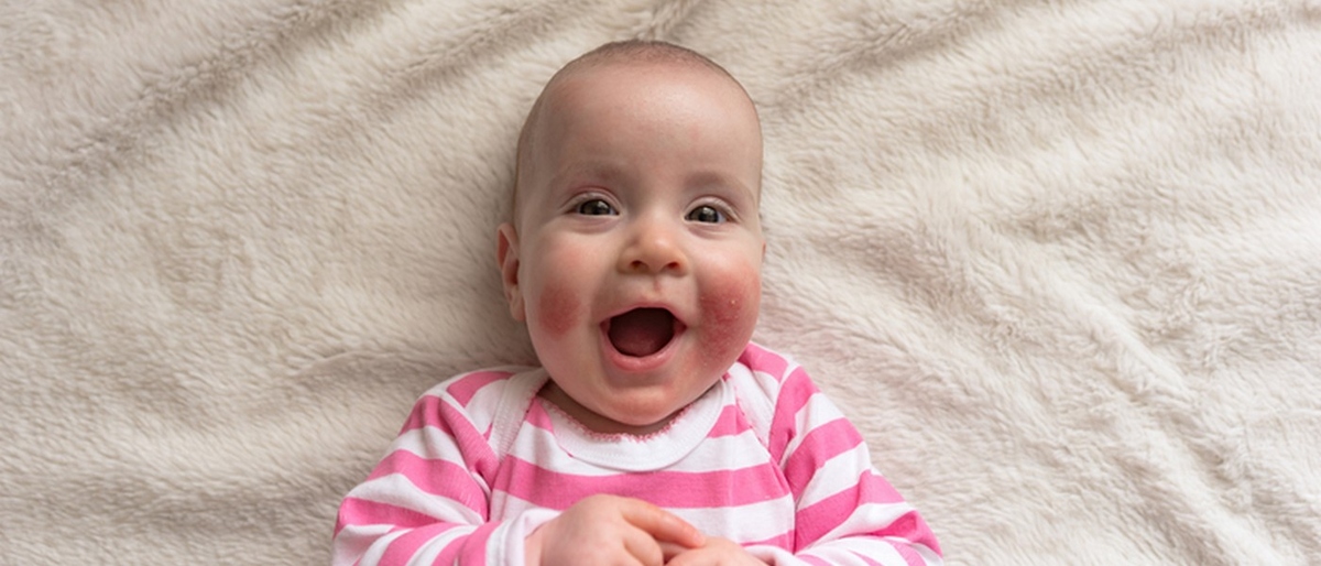 Stelatopia® Intense