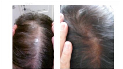 Pousse des cheveux, Croissance des cheveux, Accélérer croissance des cheveux, Chevelure dense, Traitement pour chevelure dense, Traitement pour plus de cheveux, Plus de cheveux, Cheveux fins, Volume cheveux, Perte de cheveux, Chute de cheveux, Calvitie, T