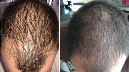 Pousse des cheveux, Croissance des cheveux, Accélérer croissance des cheveux, Chevelure dense, Traitement pour chevelure dense, Traitement pour plus de cheveux, Plus de cheveux, Cheveux fins, Volume cheveux, Perte de cheveux, Chute de cheveux, Calvitie, T