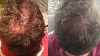 Pousse des cheveux, Croissance des cheveux, Accélérer croissance des cheveux, Chevelure dense, Traitement pour chevelure dense, Traitement pour plus de cheveux, Plus de cheveux, Cheveux fins, Volume cheveux, Perte de cheveux, Chute de cheveux, Calvitie, T