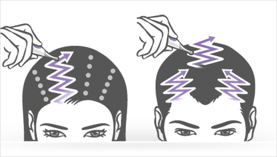 ...un flacone al giorno, che va applicato sul cuoio capelluto con movimenti a zig-zag. In questo progetto vogliamo...