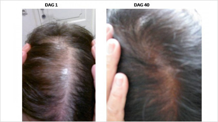 Haar groeien, Haargroei versnellen, Voller haar, Behandeling voller haar, Meer haar, Dunner haar, Behandeling voor meer haar, Haar volume, haaruitval, kaalheid, haarverlies, tegen kaalheid, behandeling haaruitval, zichtbaar hoofdhuid.