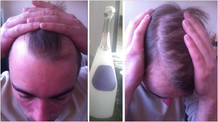 Haar groeien, Haargroei versnellen, Voller haar, Behandeling voller haar, Meer haar, Dunner haar, Behandeling voor meer haar, Haar volume, haaruitval, kaalheid, haarverlies, tegen kaalheid, behandeling haaruitval, zichtbaar hoofdhuid.