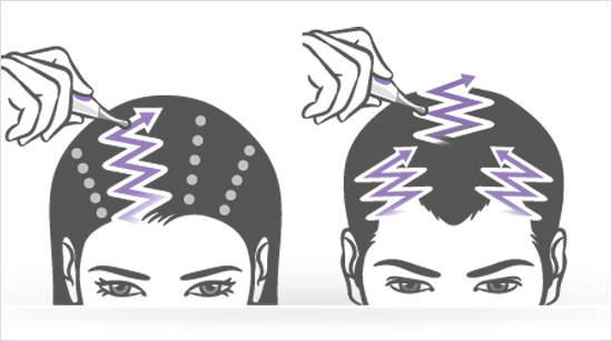 … breng je dagelijks in een zig-zag beweging op de hoofdhuid aan, met behulp van de applicator uit je startpakket. In dit project gaan we …