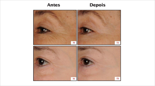 Testes clínicos comprovam que a pele se transforma desde a primeira aplicação do Cuidado Dia Revitalift Laser X3. Estes são os resultados após quatro semanas: pele mais firme e densa.